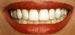 Casos de Prótese Dentária. Análise comparativa e preços. Casos de Prótese Dentária. Análise comparativa e preços.